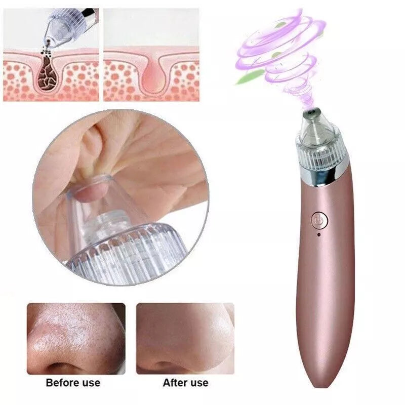 Blackhead Remover Vacuum Acne Cleaner
