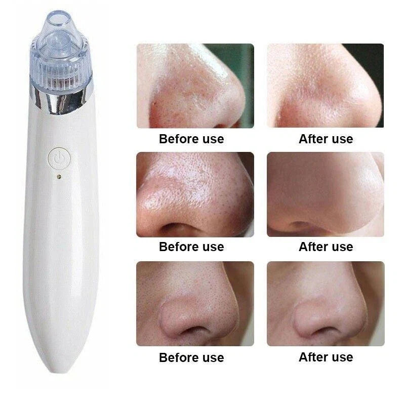 Blackhead Remover Vacuum Acne Cleaner